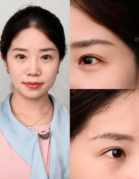 颜子云双眼皮案例