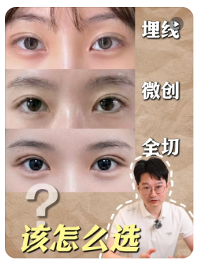 卢尚兵双眼皮