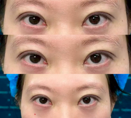 张亚伟双眼皮