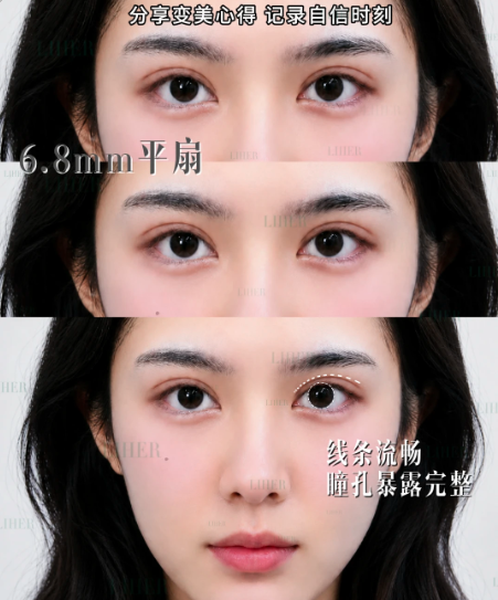 郭锋双眼皮案例