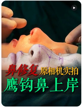 钟德成鼻修复案例