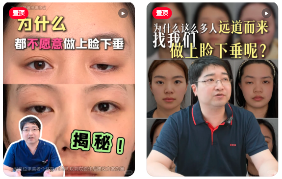 北京王维上睑下垂