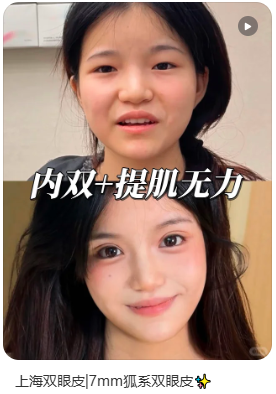 罗施案例