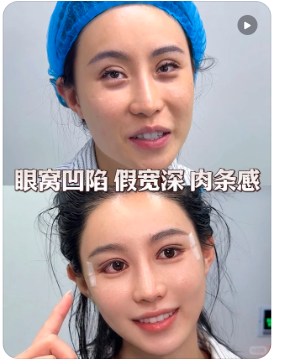 双眼皮修复