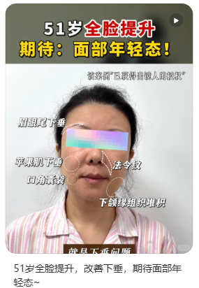 拉皮