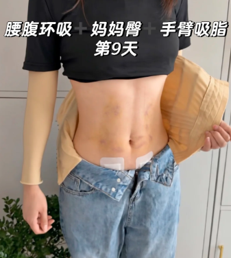 吸脂案例