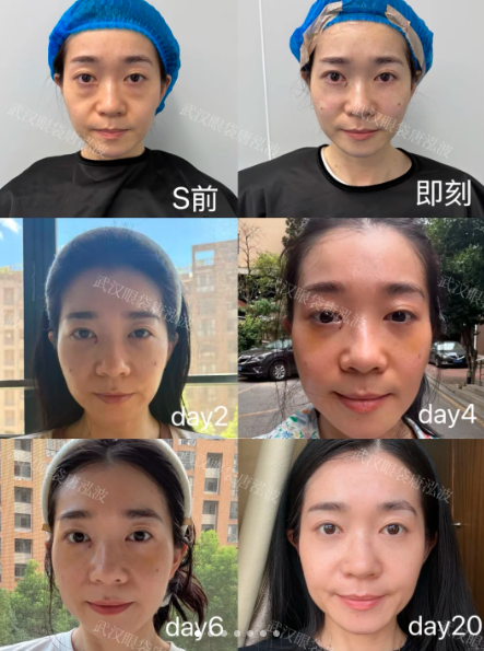 去眼袋案例