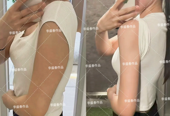 武汉吸脂案例