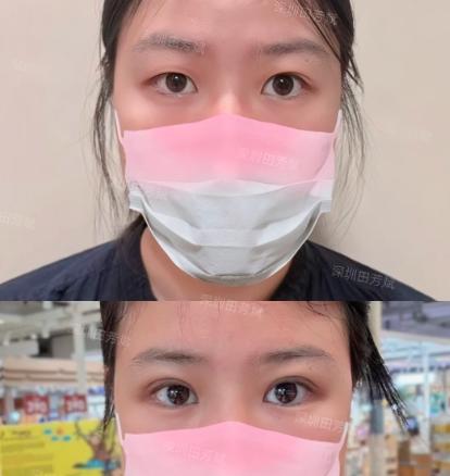 深圳割双眼皮