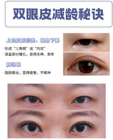 深圳公立医院谁双眼皮技术好？于丽和李天石哪个医生割双眼皮效果好？