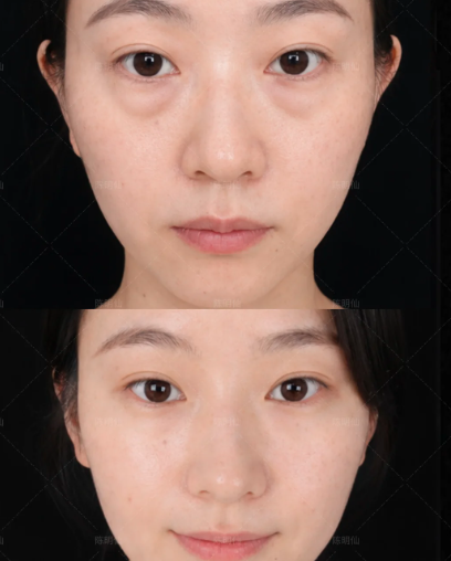 昆明去眼袋谁做得好？洪晓娅和陈明仙谁做祛眼袋技术好不复发？