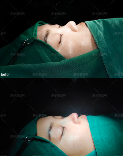 成都隆鼻修复医生隆鼻卿勇和周柯谁做鼻修复好？