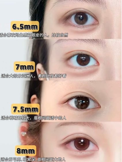双眼皮案例