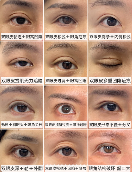 福州双眼皮