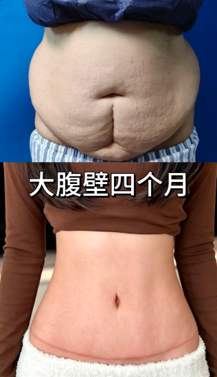 腹壁成形案例
