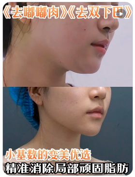 成都面部吸脂案例