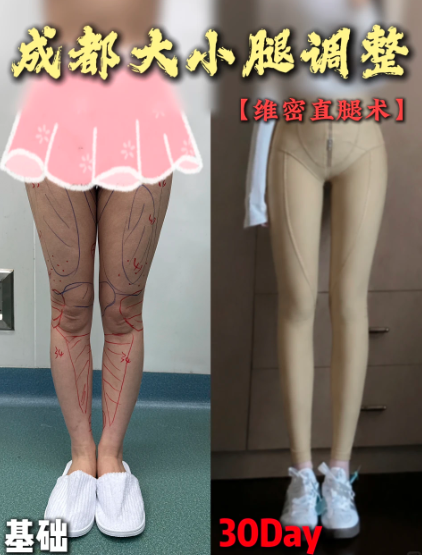 成都直腿术案例