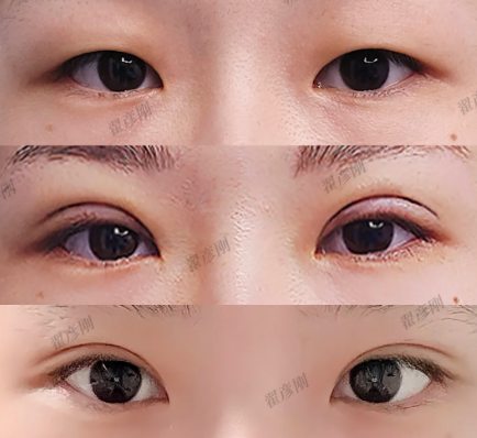 双眼皮案例