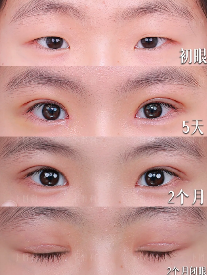 天津割双眼皮案例