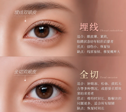 割双眼皮