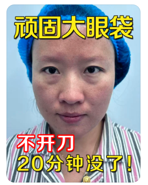 眼袋